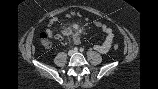 Mesenteric Panniculitis or Sclerosing mesenteritis [upl. by Nolyd]