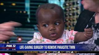 Baby Dominique Receives LifeSaving Surgery To Remove Parasitic Twin [upl. by Ariajay668]