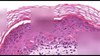 Erythema Multiforme Dermatopathology Easy learning [upl. by Atirec]