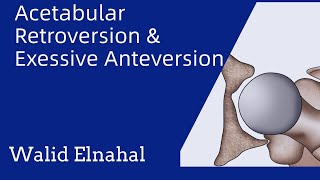 Understanding acetabular retroversion amp excessive anteversion  English Version [upl. by Winona]