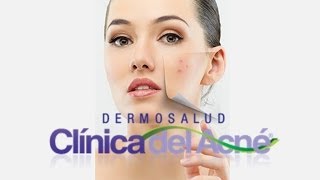 Roacutan o Isotretinoina sus Efectos Secundarios en Tratamiento para el Acne en Bogota [upl. by Latsyrhc]