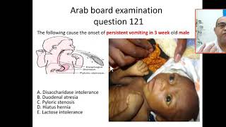 MCQ 121 how to approach for CHIPS pyloric stenosis string sign hypokalemic metabolic alkalosis [upl. by Suidualc]