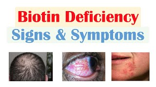 Biotin Vit B7 Deficiency Signs amp Symptoms amp Why They Occur [upl. by Haldane754]