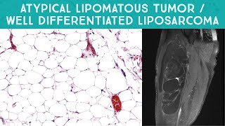 Well differentiated liposarcoma  quotAtypical lipomatous tumorquot mimicking lipoma Oregon Case 13 [upl. by Merari908]