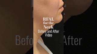 Before amp After RFAL for the Neck liposuction [upl. by Noslien]