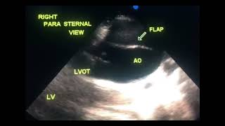 Asymptomatic dissection of aorta to drahmadmirdamadisiJSbA7GCDIDSLEpD [upl. by Brendon]