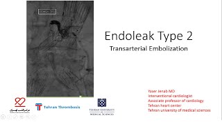 Endoleak Type 2 Transarterial Embolization [upl. by Selrahc]