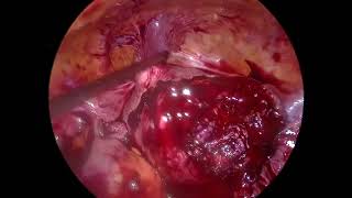 Myomectomy Laparoscopic SKAFF [upl. by Aneehsor357]