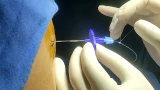 Lumber Epidural Catheterization For Anaesthesia amp Pain Management [upl. by Nodnil]