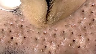 Big Cystic Acne Blackheads Extraction Blackheads amp Milia Whiteheads Removal Pimple Popping  2545 [upl. by Doowrehs]