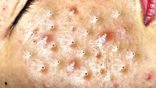 Big Cystic Acne Blackheads Extraction Blackheads amp Milia Whiteheads Removal Pimple Popping  3032 [upl. by Bax]