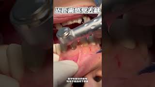 Cavity Removal  Cavity Preparation For Filling [upl. by Nas685]