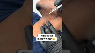 ingrown hair removal 😌 [upl. by Lamberto]