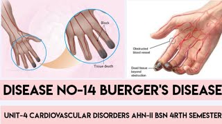 Buergers DiseaseDisease No14Unit4 Cardiovascular DisordersAHNIIBSN 4rth semesterIn Urdu [upl. by Chet890]