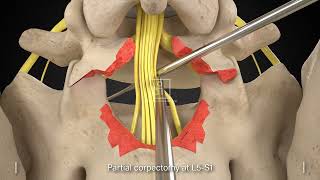 L5S1 Lumbar Fusion [upl. by Munro]