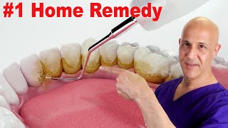 1 Home Remedy to Remove Dental Plaque amp Tarter to Prevent Cavities  Dr Mandell [upl. by Nytsud]