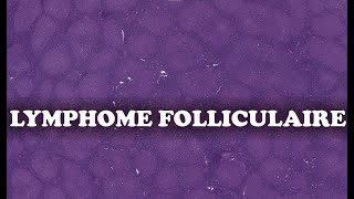 LE LYMPHOME FOLLICULAIRE  PATHOLOGIE [upl. by Siram13]