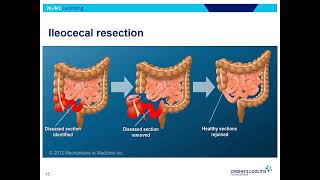 Surgery for ulcerative colitis What is pouchitis [upl. by Annecorinne]