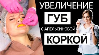 Увеличение губ с апельсиновой коркой [upl. by Anayra]