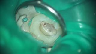 Pulpotomy with MTA [upl. by Prosser]