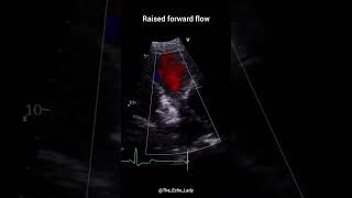 Pulmonary Stenosis 🩵 echocardiogram echocardiography cardiology PulmonaryValve congenital [upl. by Eerot144]