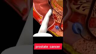 PROSTATE CANCER  PROSTATE CANCER ANIMATION howtogetsuccessinlife biologyislife getsuccess [upl. by Weinman470]