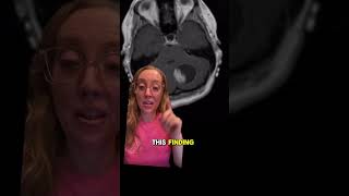 Case study 124  Pilocytic astrocystoma EXPLAINED by a boardcertified neurosurgeon [upl. by Aillimac456]