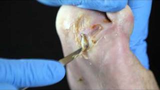 Debridement of a diabetic foot ulcer [upl. by Latt]