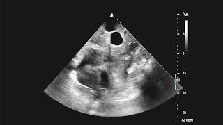 Pericardial Tamponade With Echo Contrast Confirmation of Pericardial Catheter Placement [upl. by Franckot636]