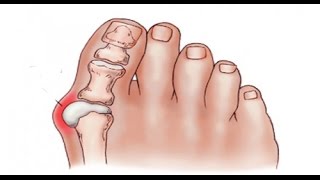 Juanetes Tratamiento con biomagnetismo 30 [upl. by Ronoh]