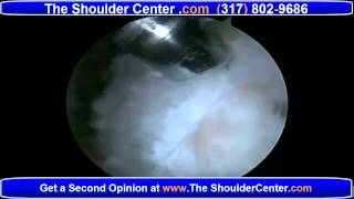 Revision Arthroscopic Rotator Cuff Repair Options [upl. by Aksehcnarf]