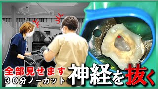 【 全部見せます 】ズキズキ痛む歯を治す！３０分ノーカット！根管 根幹 歯医者 [upl. by Ailem153]