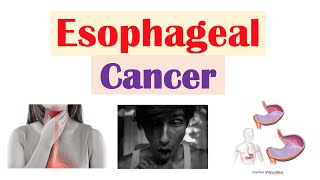 Esophageal Cancer  Risk Factors Pathogenesis Signs and Symptoms Diagnosis Treatment [upl. by Vlad]