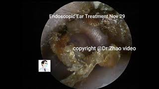 Tympanic membrane perforation and postoperative debridement for cholesteatoma [upl. by Nirak]