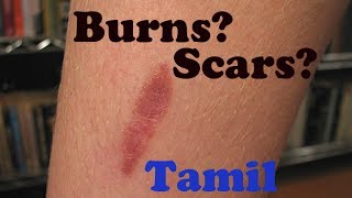 How to treat Burns and Scars  Tamil [upl. by Itsuj]