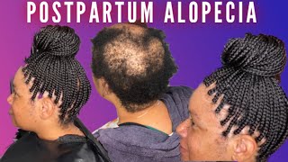 Postpartum Alopecia Box Braid Coverup [upl. by Moreville]