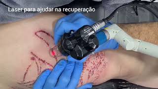 Remoção de Tatuagem com Anestesia Multiplos lasers associados a técnica equivale a 3 sessões em 1 [upl. by Nadroj]