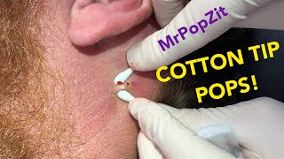 A quick popping session to hold you over Shallow follicular cysts extracted With Bonus blackhead [upl. by Aisenat]