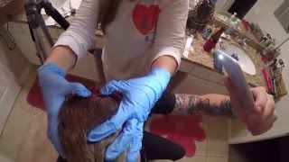 At Home Pilar Cyst Removal [upl. by Cogn]