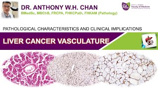 Liver Cancer Vasculature  Pathological Characteristics and Clinical Implications [upl. by Nrol422]