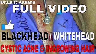 COMEDONES and CYSTIC ACNE POPPING FULL VIDEO 2 [upl. by Nosinned]