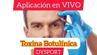 Aplicación de TOXina BOTulínica  DYSPORT dysport toxinabotulinica drchapul DysportMexico [upl. by Arramahs]