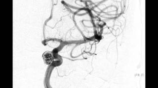 Neurointerventional Stroke Rounds  Aneurysm Coiling [upl. by Doll338]