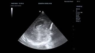 TCUS SSS thrombosis thalamic hemorrhage PVL [upl. by Eenoj]