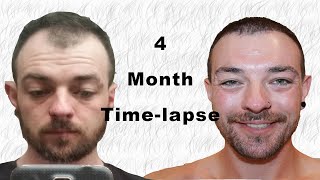 Hair Transplant Timelapse 04 months [upl. by Wenz]