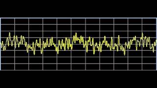 Thalamic Diseases  Rife Frequencies [upl. by Catlee]