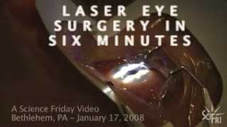 LASIK Eye Surgery in Six Minutes [upl. by Gallard]