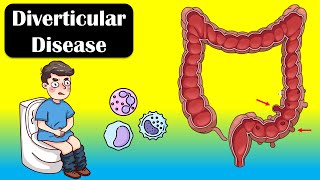 Diverticular Disease And Diverticulitis  Causes Signs amp Symptoms Diagnosis Treatment [upl. by Nosilla197]