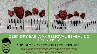 DEEP DRY EAR WAX REMOVAL REVEALING EXOSTOSIS  EP 280 [upl. by Perpetua]