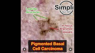 Pigmented Basal Cell Carcinoma [upl. by Shepperd]